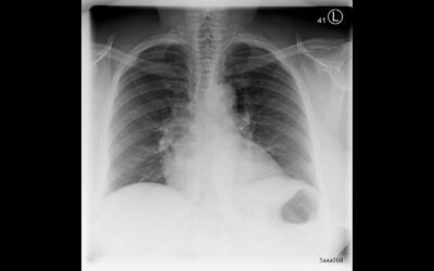 Longitudinal Assessment of Chest CT Findings and Pulmonary Function in Patients after COVID-19