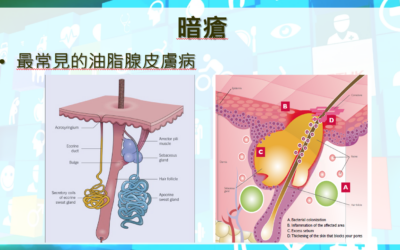 RTHK 精靈一點：2023.02.14 暗瘡