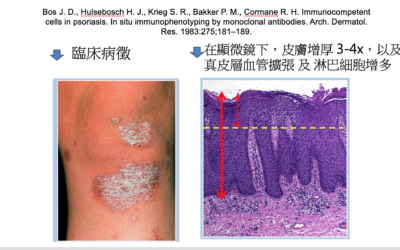 RTHK 精靈一點：2023.01.24 西醫治療銀屑病  （2）