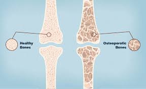 Clear Opportunity to Identify Patients With Osteoporosis Commonly Missed