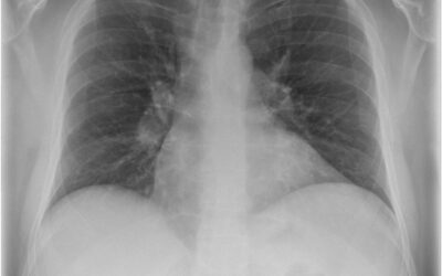 New-onset sarcoidosis in a patient with long COVID