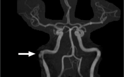 Spontaneous Right Intrapetrous Internal Carotid Dissection in a Patient With Active COVID-19