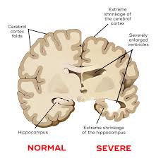 Expert Panel: Target These 14 Factors to Cut Dementia Incidence by Nearly Half