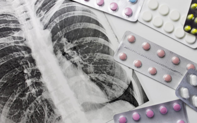 TB-COVID co-infections increasingly common, tied to worse outcomes, data show