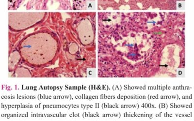 Expression of antigen-presenting cells in lung of postmortem SARS-CoV-2 cases