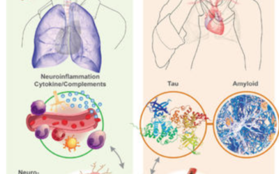 UK researchers find Alzheimer’s-like brain changes in long COVID patients