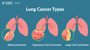 ACS Guidelines Expand Lung Cancer Screening Eligibility — Is That a Good Thing?