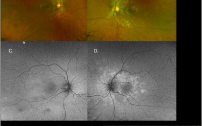 Multimodal Imaging Findings of Multiple Evanescent White Dot Syndrome in COVID-19 Patients