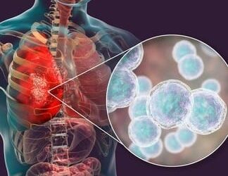 Microbial dynamics and pulmonary immune responses in COVID-19 secondary bacterial pneumonia