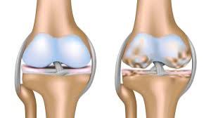 Minimally Invasive Procedure May Reduce Symptoms of Knee Osteoarthritis