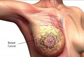 Skipping Chest-Wall Irradiation After Mastectomy in Intermediate-Risk Breast Cancer